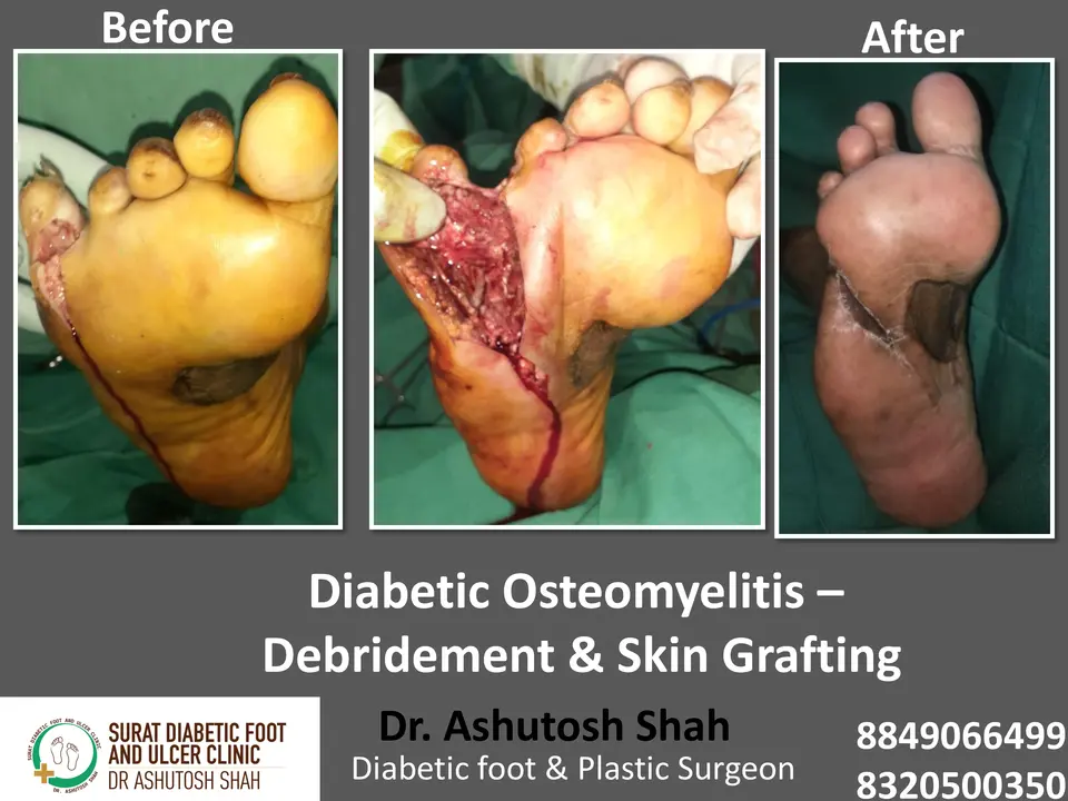 Diabetic Foot  PPT sunita.pptx-32.webp